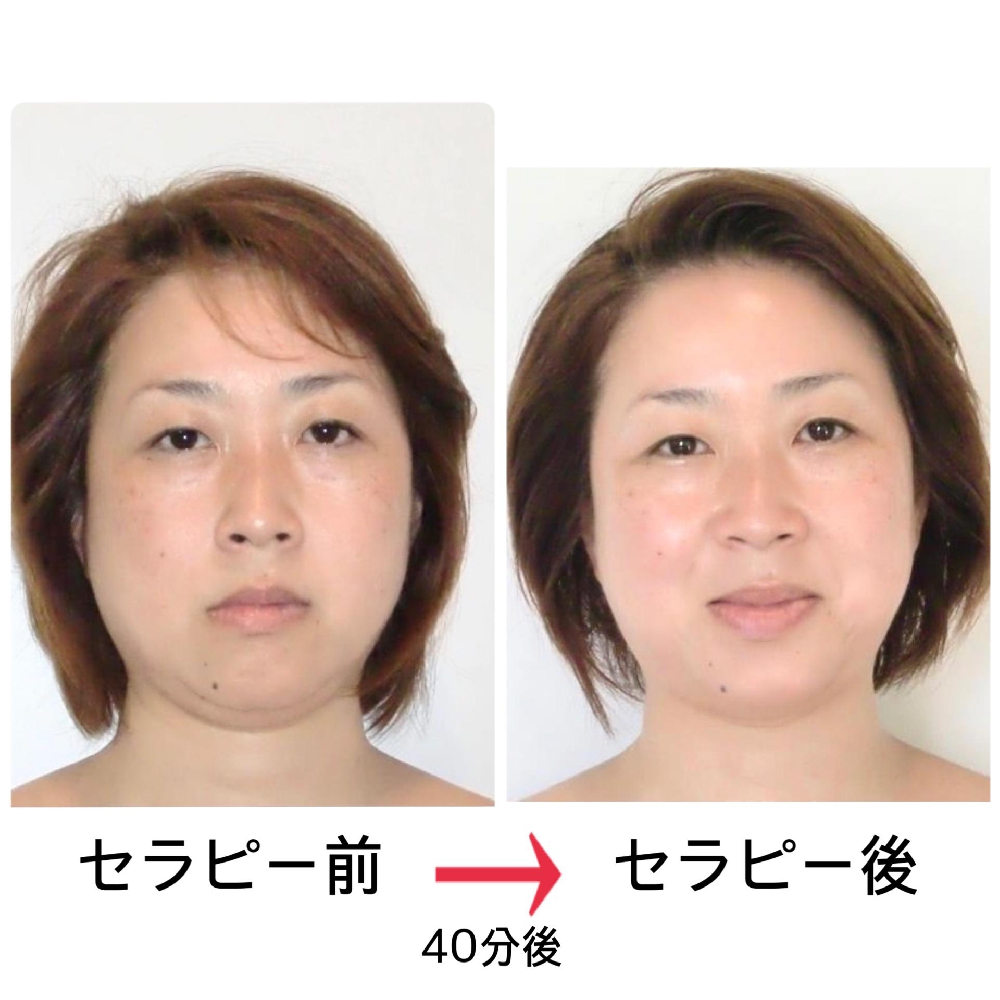人気の深層顔筋セラピー