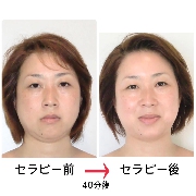 人気の深層顔筋セラピー